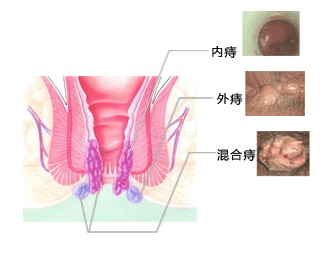 痔疮类型.jpg